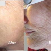 Tips for preventing wrinkles and skin aging