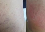 Laser spider veins treatment