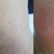 Laser spider veins treatment