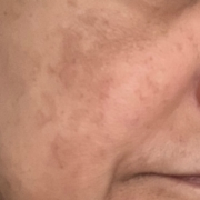 Melasma, Ochronosis causes
