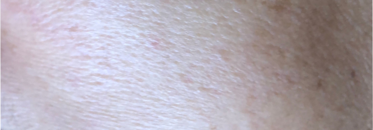 Solutions for Brown Spots, Age Spots, Sun spots removal!