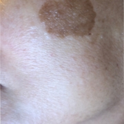 Solutions for Brown Spots, Age Spots, Sun spots removal!