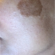 Solutions for Brown Spots, Age Spots, Sun spots removal!