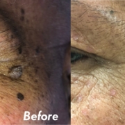 Remove Warts and Skin Tags Effortlessly