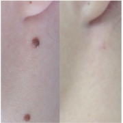 A Causes of Acne, Skin Tags, & Facial Hair Growth