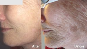 IPL PHOTO-REJUVENATION IPL PHOTO-REJUVENATION