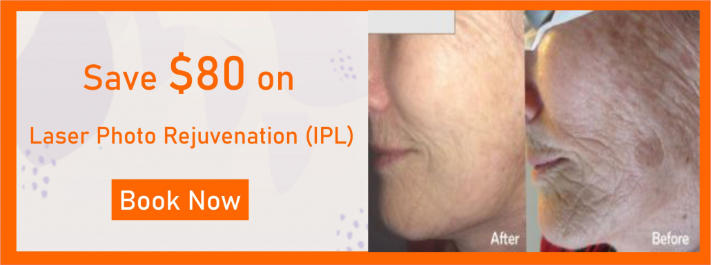 Laser Photo-Rejuvenation (IPL), Toronto, North York, Nell Laser Clinic (1)