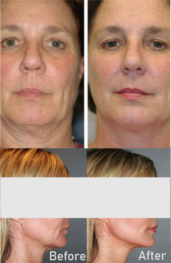 Facelift 3D HIFU, Double Chin, Nell Laser Clinic,,